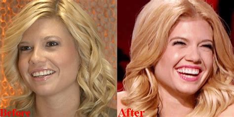 chanel west coast teeth fake|chanel plastic surgery before and after.